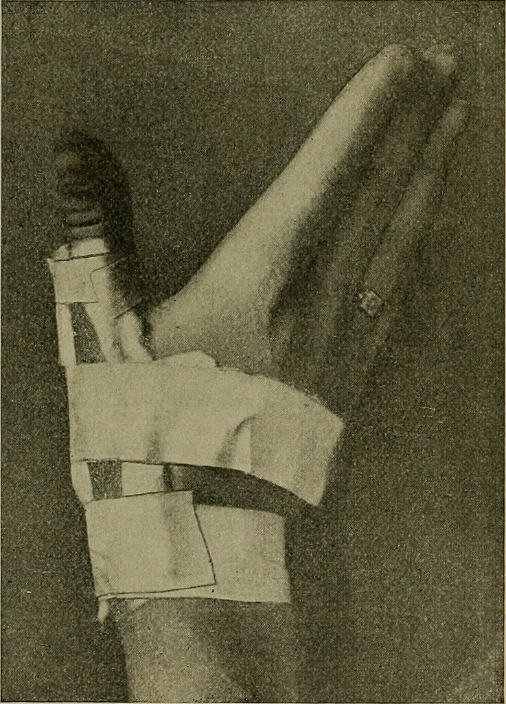 An illustration from Modern surgery, general and operative / by John Chalmers DaCosta., 1914, leaf 601