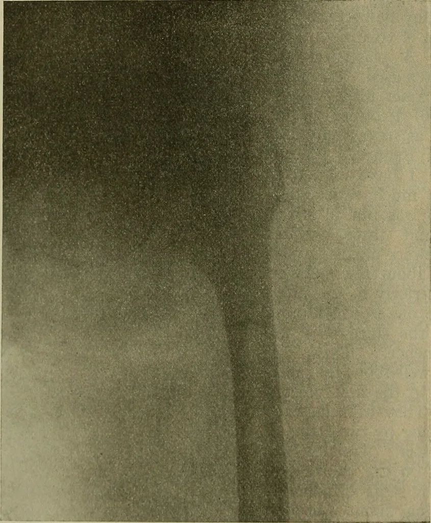 An illustration from Modern surgery, general and operative / by John Chalmers DaCosta., 1914, leaf 602