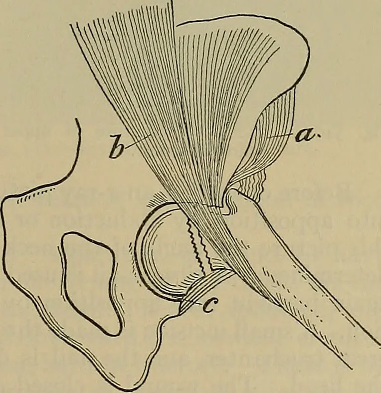 An illustration from Modern surgery, general and operative / by John Chalmers DaCosta., 1914, leaf 611