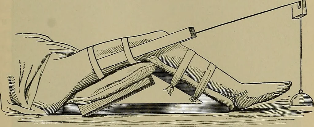 An illustration from Modern surgery, general and operative / by John Chalmers DaCosta., 1914, leaf 615