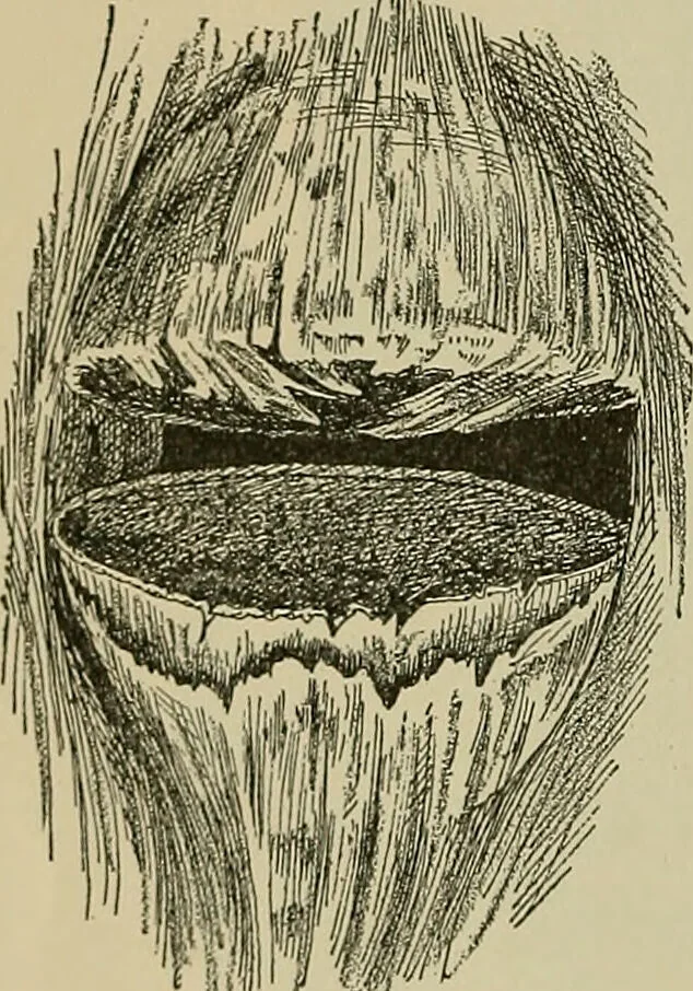An illustration from Modern surgery, general and operative / by John Chalmers DaCosta., 1914, leaf 624