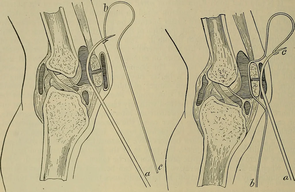 An illustration from Modern surgery, general and operative / by John Chalmers DaCosta., 1914, leaf 626