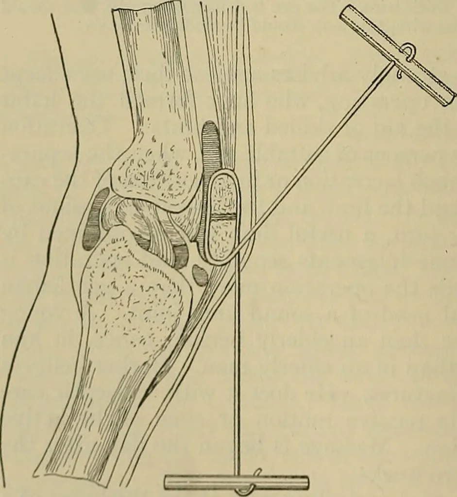 An illustration from Modern surgery, general and operative / by John Chalmers DaCosta., 1914, leaf 626