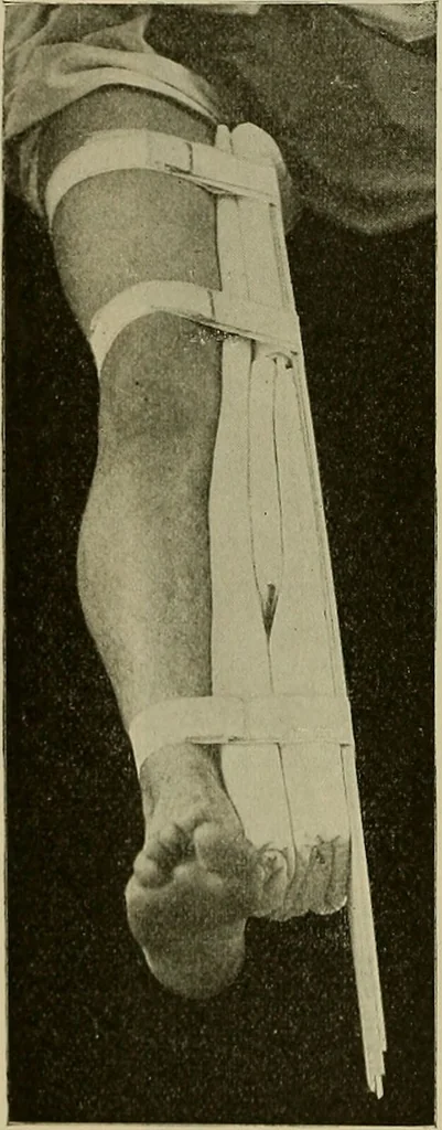 An illustration from Modern surgery, general and operative / by John Chalmers DaCosta., 1914, leaf 632
