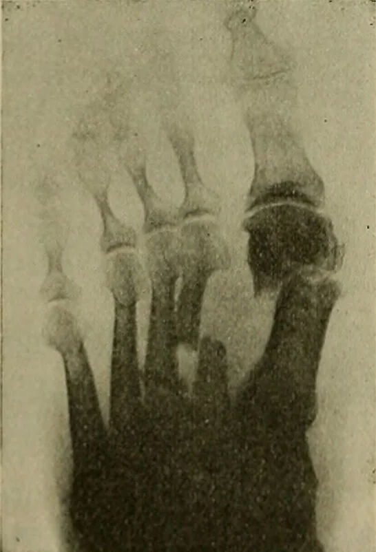 An illustration from Modern surgery, general and operative / by John Chalmers DaCosta., 1914, leaf 636