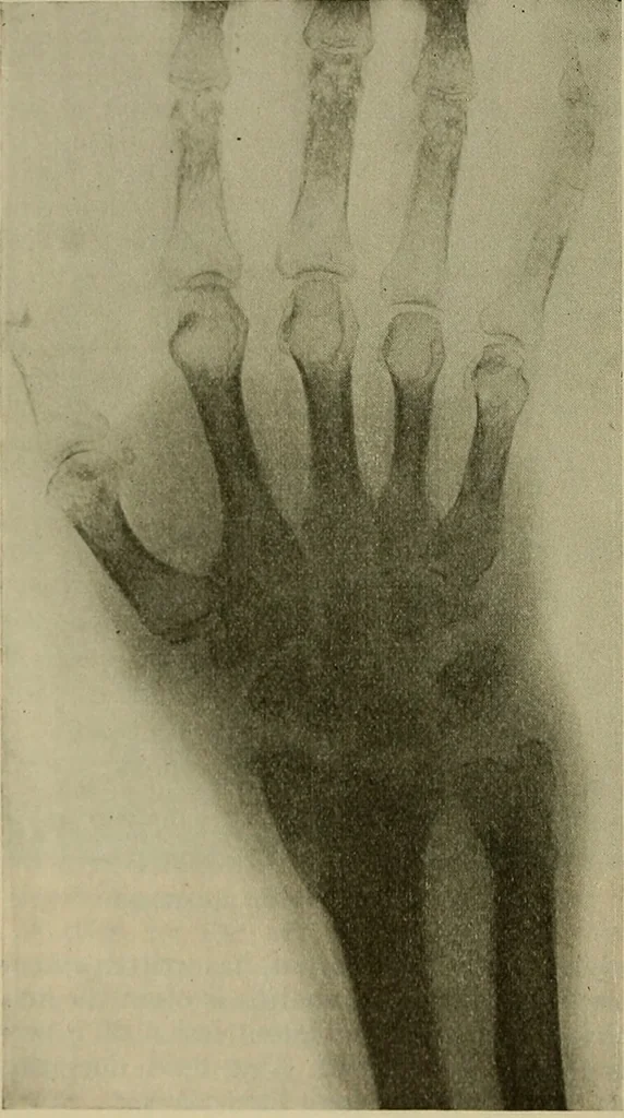 An illustration from Modern surgery, general and operative / by John Chalmers DaCosta., 1914, leaf 640