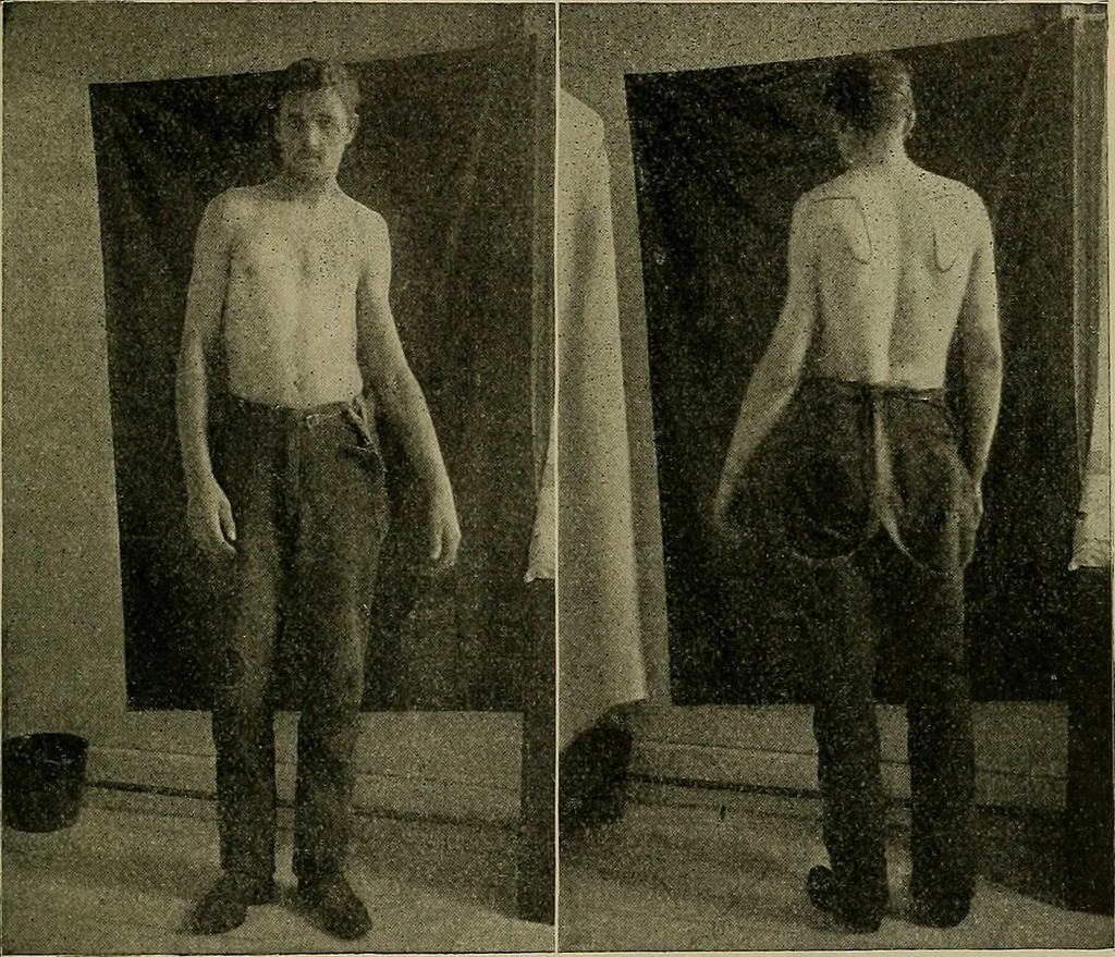 An illustration from Modern surgery, general and operative / by John Chalmers DaCosta., 1914, leaf 685
