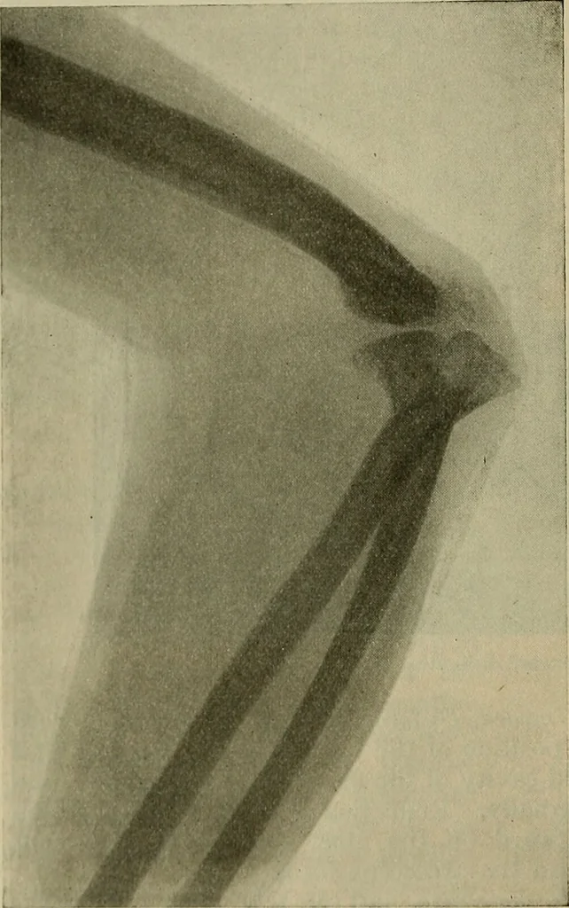 An illustration from Modern surgery, general and operative / by John Chalmers DaCosta., 1914, leaf 694