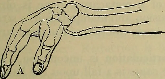 An illustration from Modern surgery, general and operative / by John Chalmers DaCosta., 1914, leaf 695