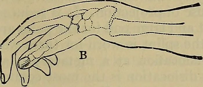 An illustration from Modern surgery, general and operative / by John Chalmers DaCosta., 1914, leaf 695