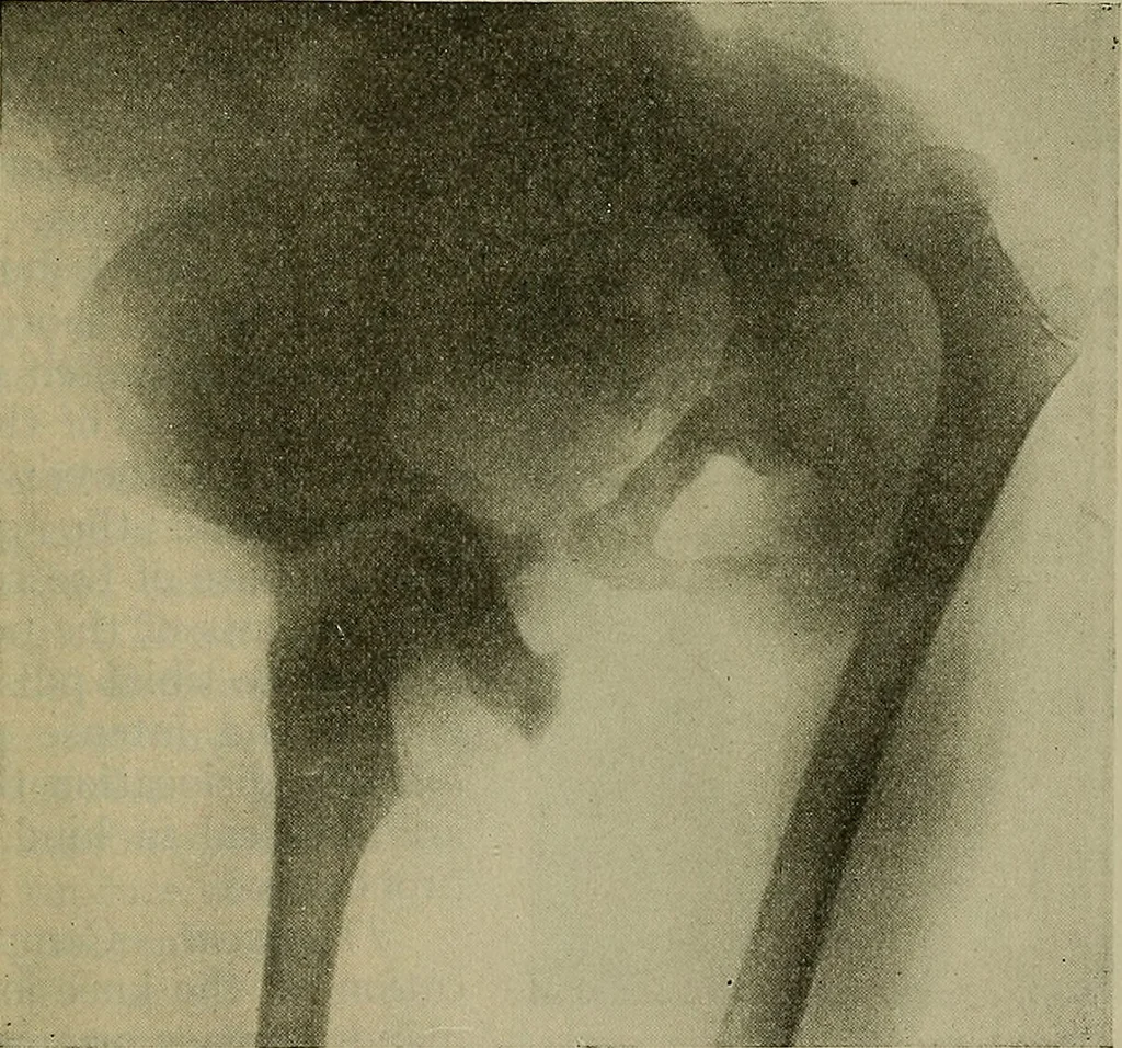 An illustration from Modern surgery, general and operative / by John Chalmers DaCosta., 1914, leaf 703