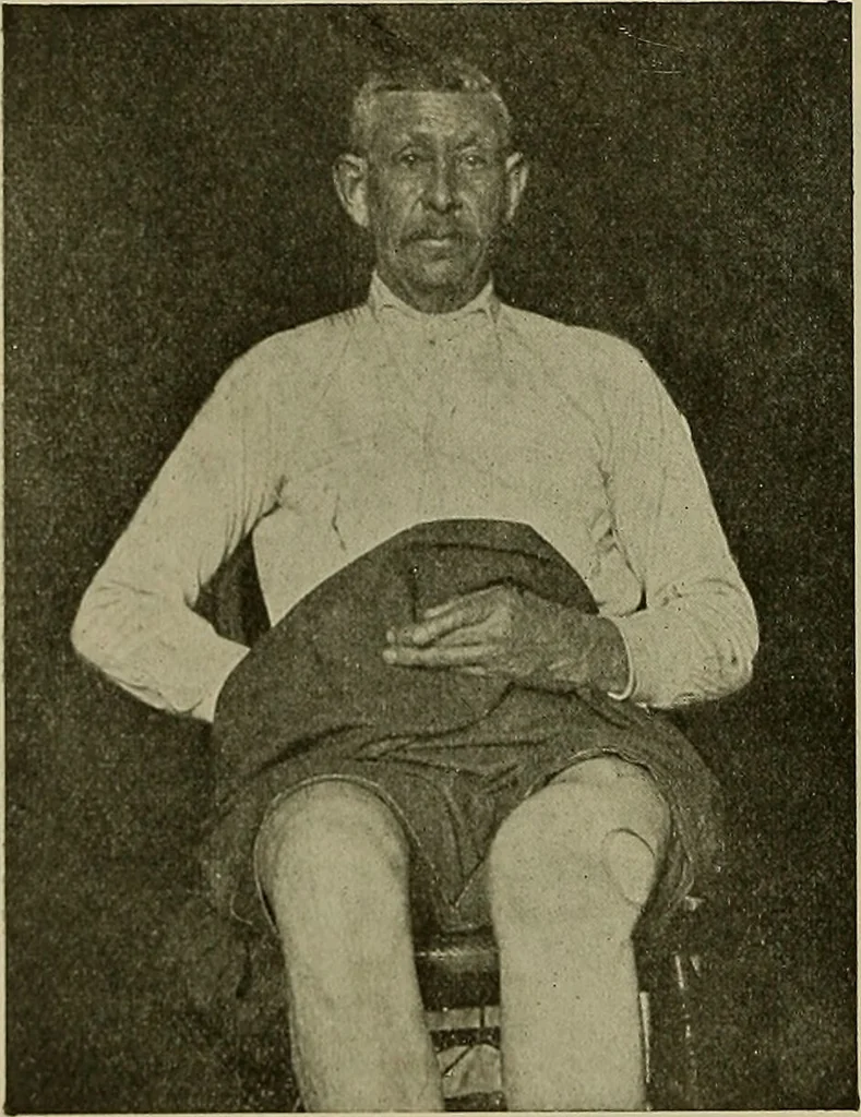 An illustration from Modern surgery, general and operative / by John Chalmers DaCosta., 1914, leaf 704