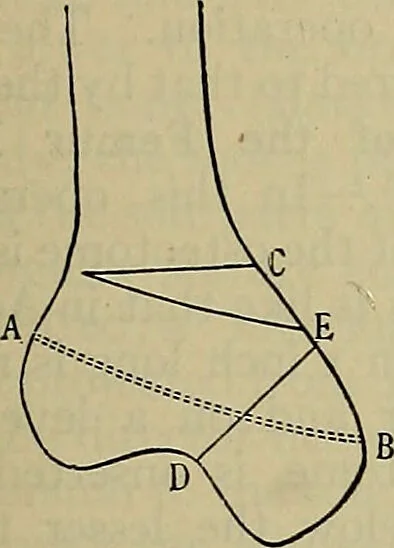 An illustration from Modern surgery, general and operative / by John Chalmers DaCosta., 1914, leaf 711