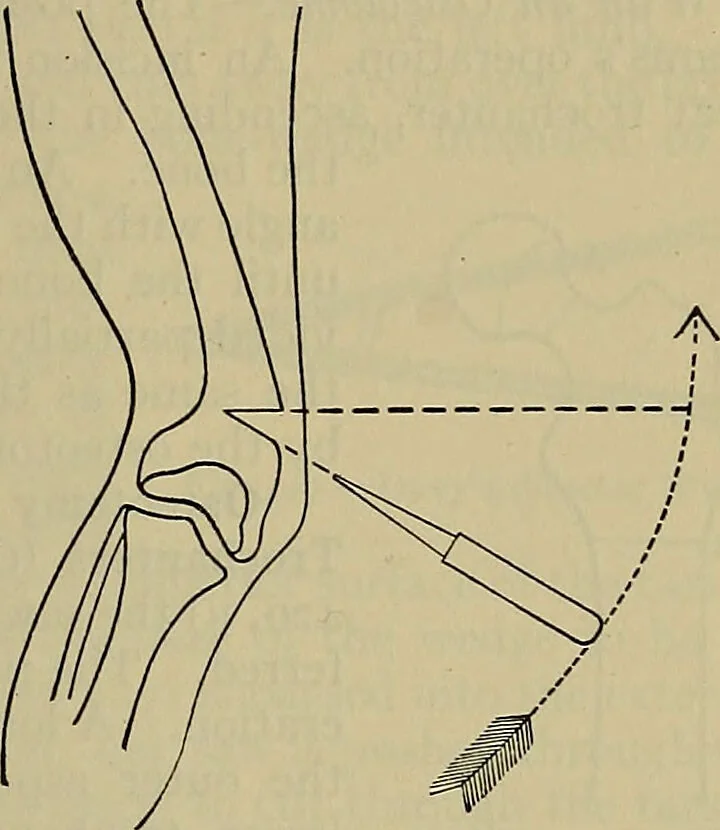 An illustration from Modern surgery, general and operative / by John Chalmers DaCosta., 1914, leaf 711