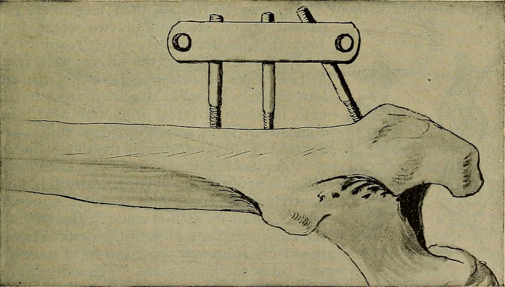 An illustration from Modern surgery, general and operative / by John Chalmers DaCosta., 1914, leaf 715