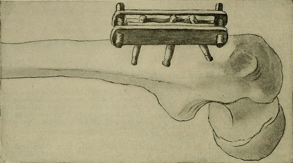 An illustration from Modern surgery, general and operative / by John Chalmers DaCosta., 1914, leaf 716