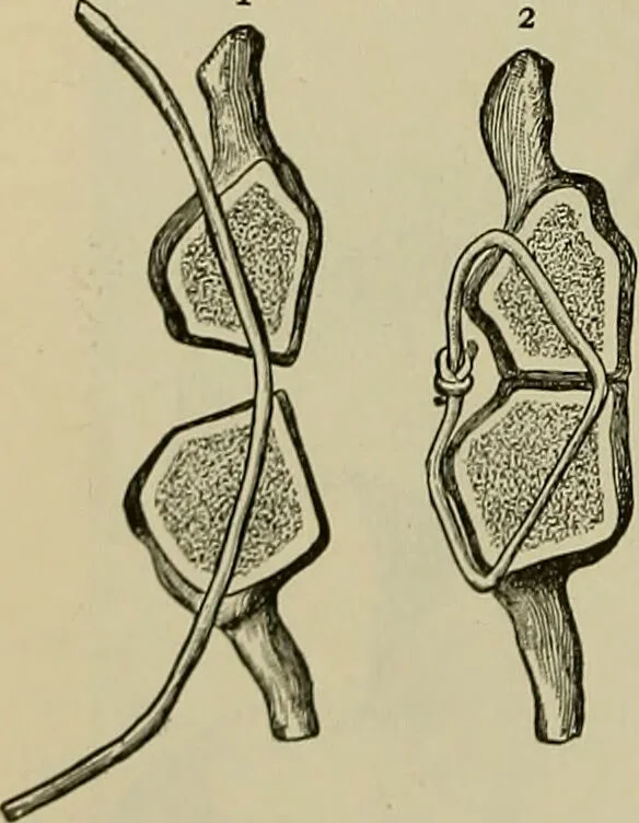 An illustration from Modern surgery, general and operative / by John Chalmers DaCosta., 1914, leaf 716