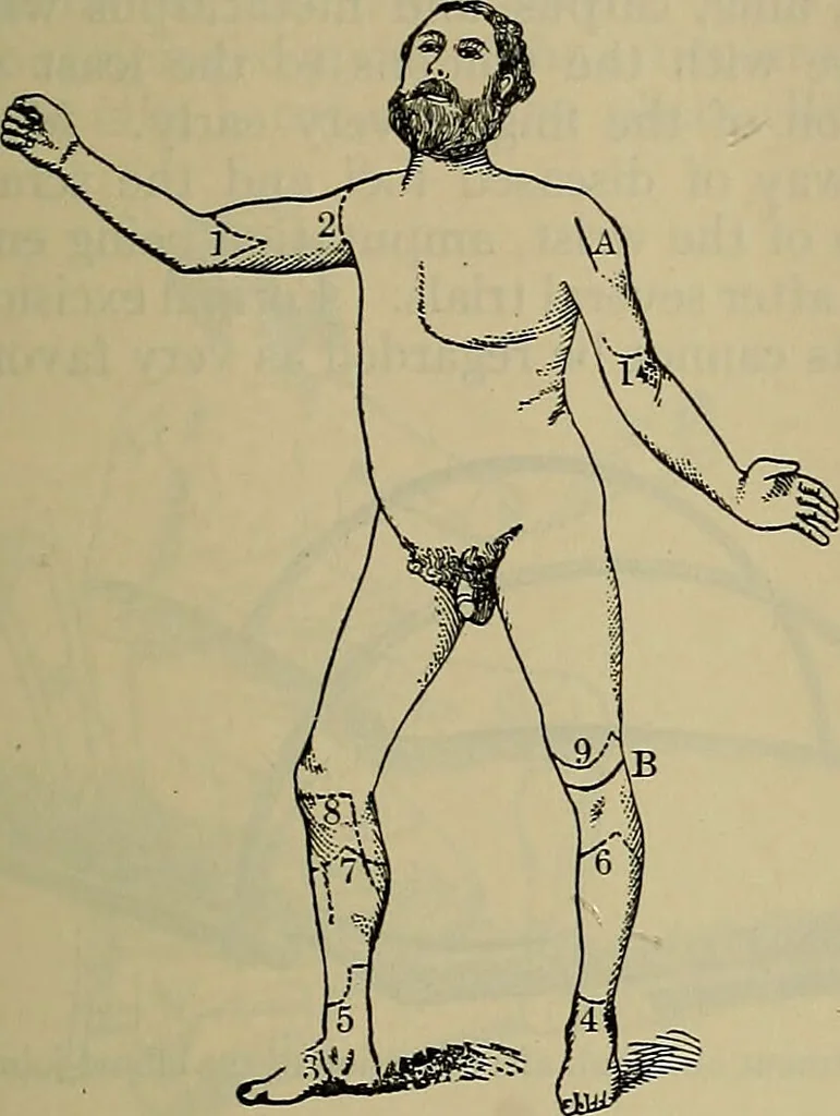 An illustration from Modern surgery, general and operative / by John Chalmers DaCosta., 1914, leaf 721