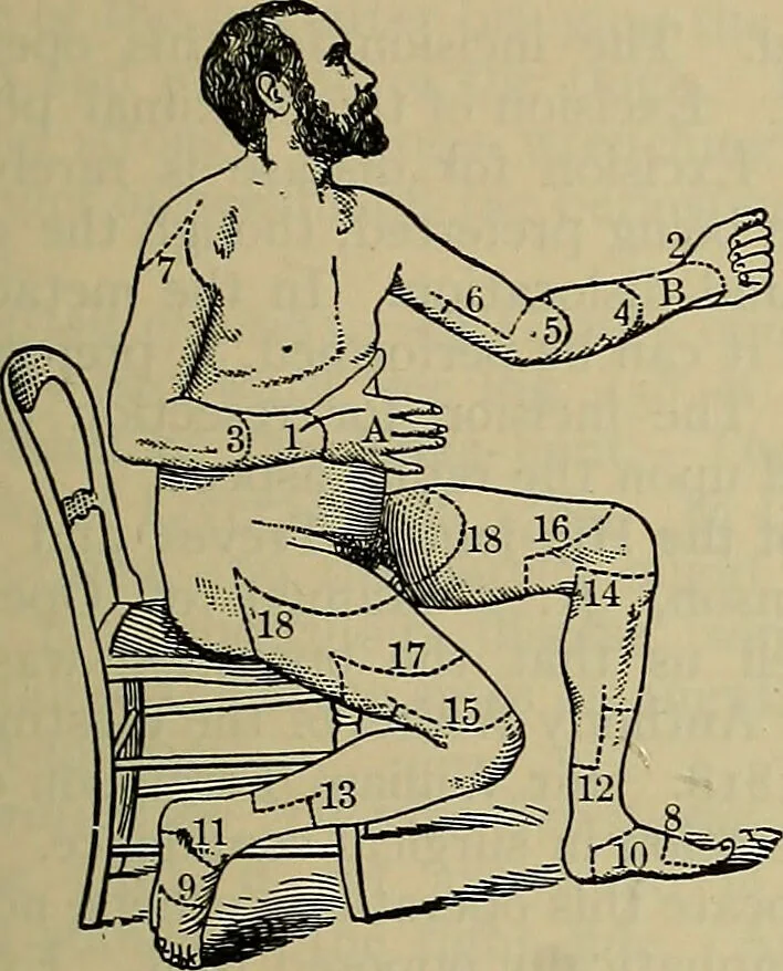An illustration from Modern surgery, general and operative / by John Chalmers DaCosta., 1914, leaf 723