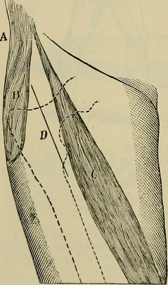 An illustration from Modern surgery, general and operative / by John Chalmers DaCosta., 1914, leaf 724