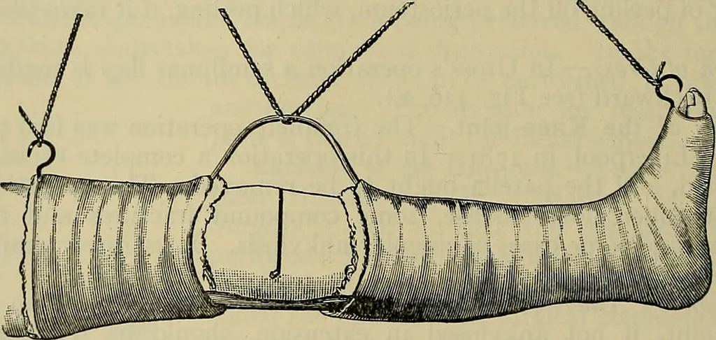 An illustration from Modern surgery, general and operative / by John Chalmers DaCosta., 1914, leaf 726