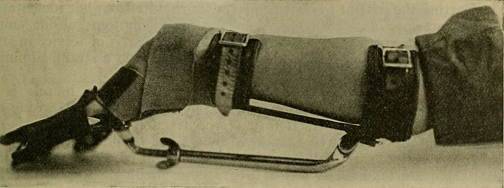An illustration from Modern surgery, general and operative / by John Chalmers DaCosta., 1914, leaf 739