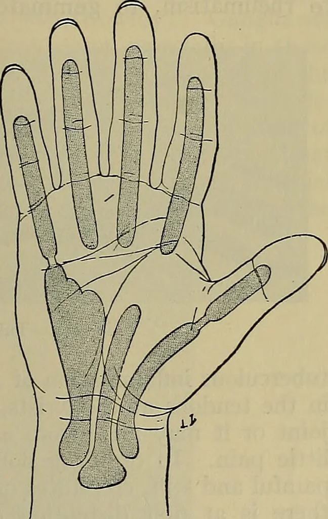 An illustration from Modern surgery, general and operative / by John Chalmers DaCosta., 1914, leaf 743
