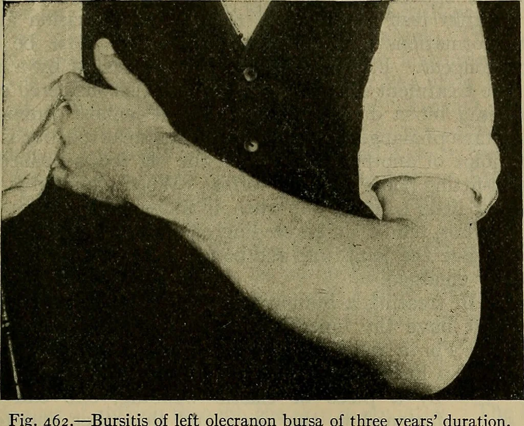 An illustration from Modern surgery, general and operative / by John Chalmers DaCosta., 1914, leaf 753