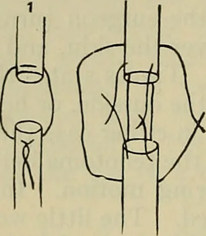 An illustration from Modern surgery, general and operative / by John Chalmers DaCosta., 1914, leaf 756