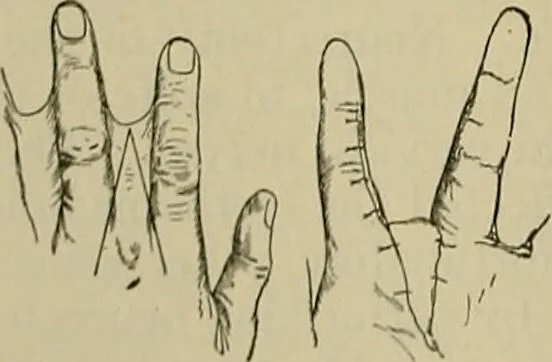 An illustration from Modern surgery, general and operative / by John Chalmers DaCosta., 1914, leaf 760