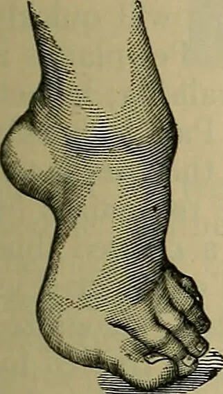 An illustration from Modern surgery, general and operative / by John Chalmers DaCosta., 1914, leaf 763