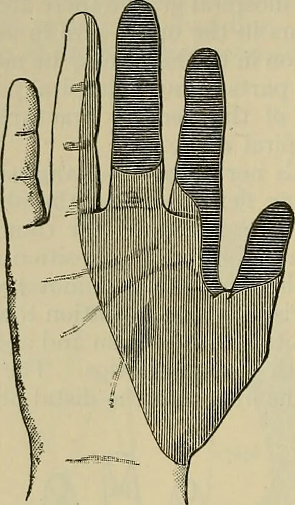 An illustration from Modern surgery, general and operative / by John Chalmers DaCosta., 1914, leaf 776