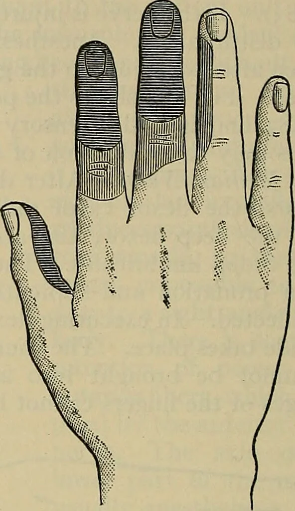 An illustration from Modern surgery, general and operative / by John Chalmers DaCosta., 1914, leaf 776