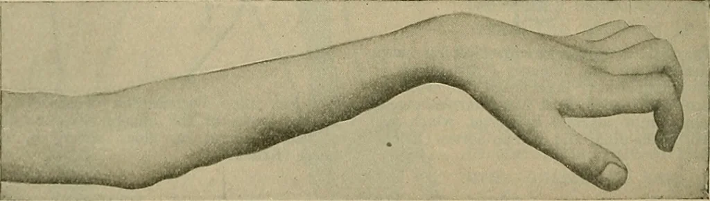 An illustration from Modern surgery, general and operative / by John Chalmers DaCosta., 1914, leaf 776
