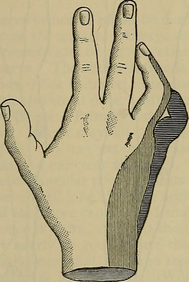 An illustration from Modern surgery, general and operative / by John Chalmers DaCosta., 1914, leaf 777