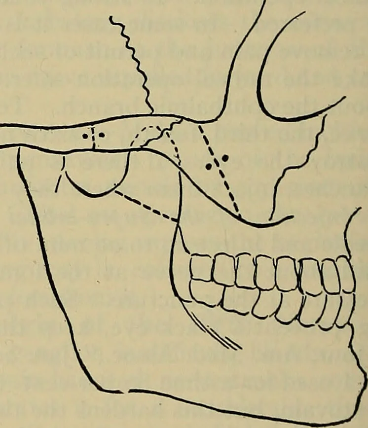 An illustration from Modern surgery, general and operative / by John Chalmers DaCosta., 1914, leaf 786