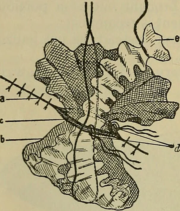 An illustration from Modern surgery, general and operative / by John Chalmers DaCosta., 1914, leaf 80