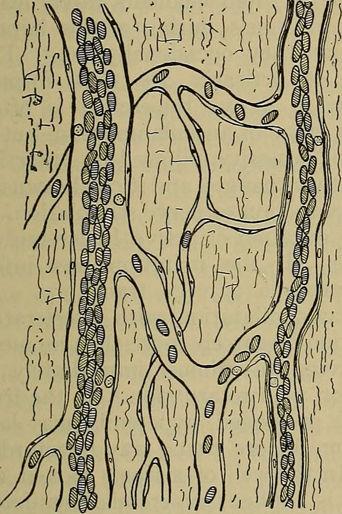 An illustration from Modern surgery, general and operative / by John Chalmers DaCosta., 1914, leaf 81