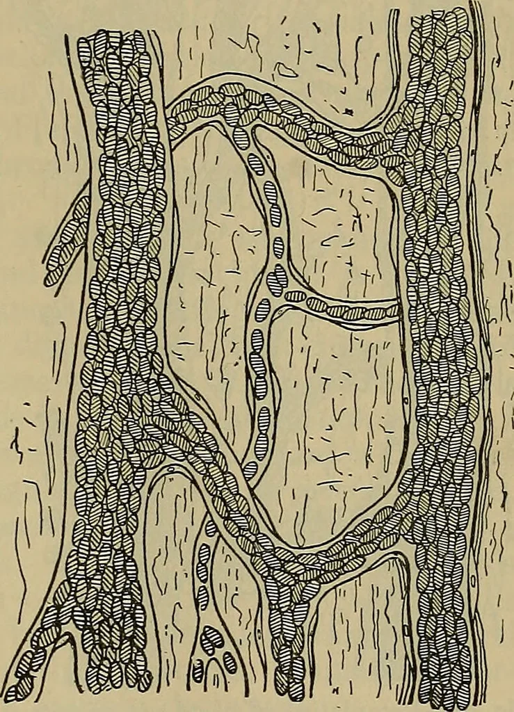 An illustration from Modern surgery, general and operative / by John Chalmers DaCosta., 1914, leaf 81