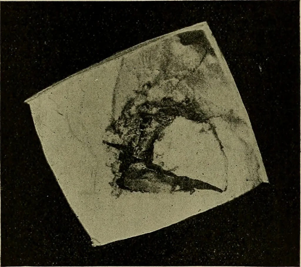 An illustration from Modern surgery, general and operative / by John Chalmers DaCosta., 1914, leaf 811