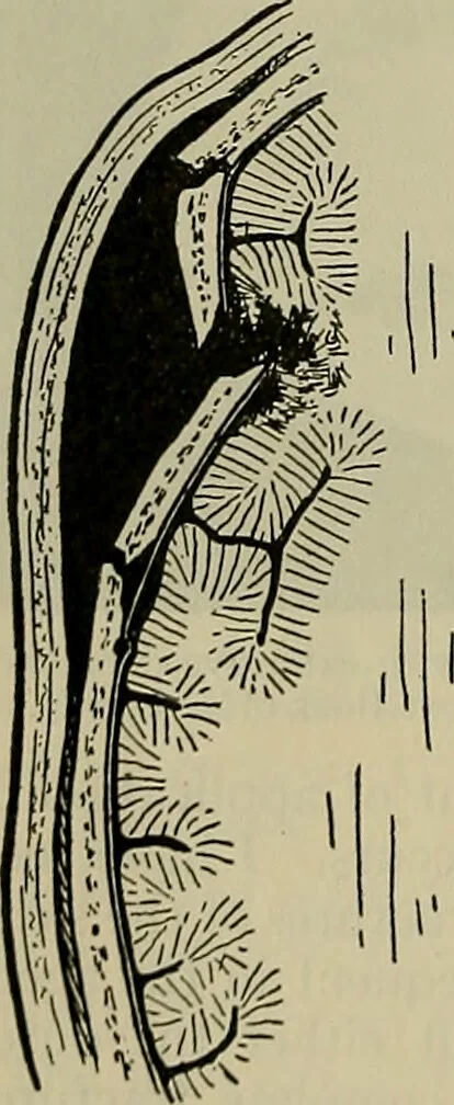 An illustration from Modern surgery, general and operative / by John Chalmers DaCosta., 1914, leaf 812
