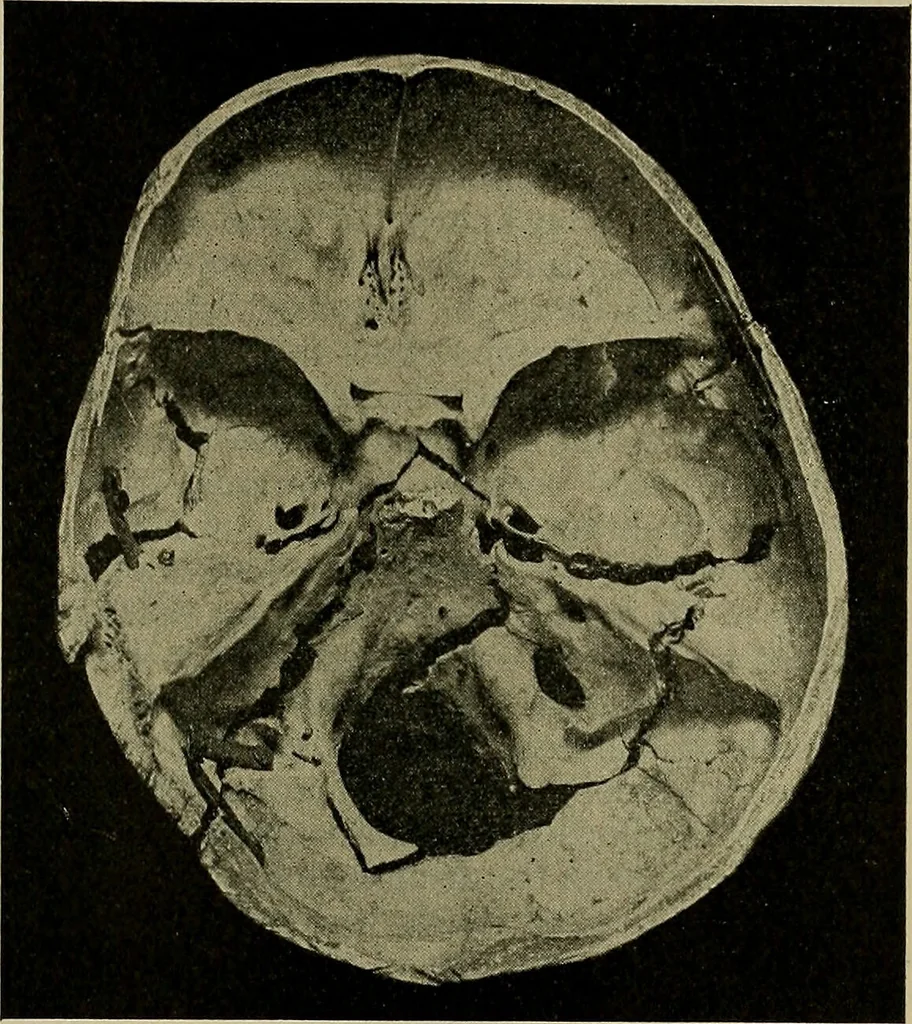 An illustration from Modern surgery, general and operative / by John Chalmers DaCosta., 1914, leaf 813