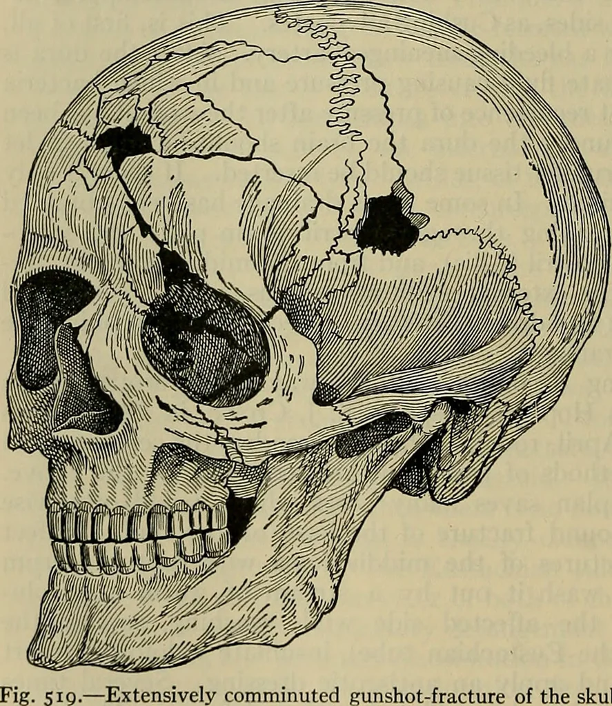 An illustration from Modern surgery, general and operative / by John Chalmers DaCosta., 1914, leaf 816