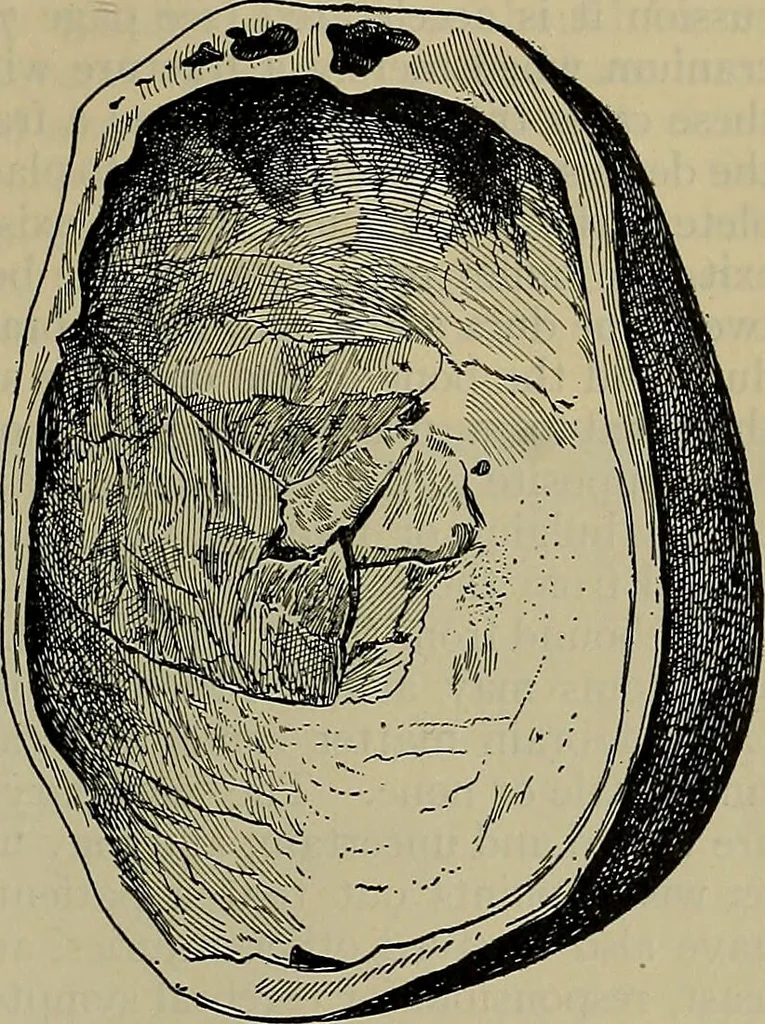 An illustration from Modern surgery, general and operative / by John Chalmers DaCosta., 1914, leaf 817
