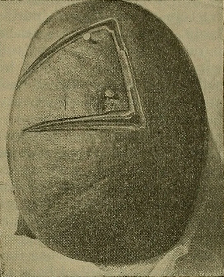 An illustration from Modern surgery, general and operative / by John Chalmers DaCosta., 1914, leaf 849