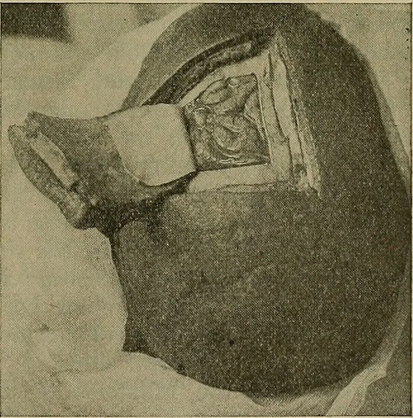 An illustration from Modern surgery, general and operative / by John Chalmers DaCosta., 1914, leaf 849