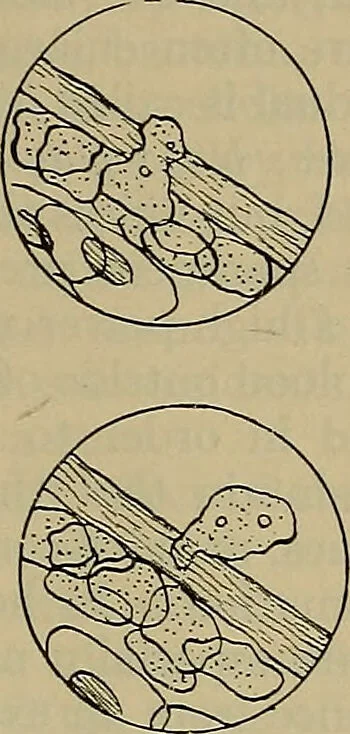 An illustration from Modern surgery, general and operative / by John Chalmers DaCosta., 1914, leaf 85