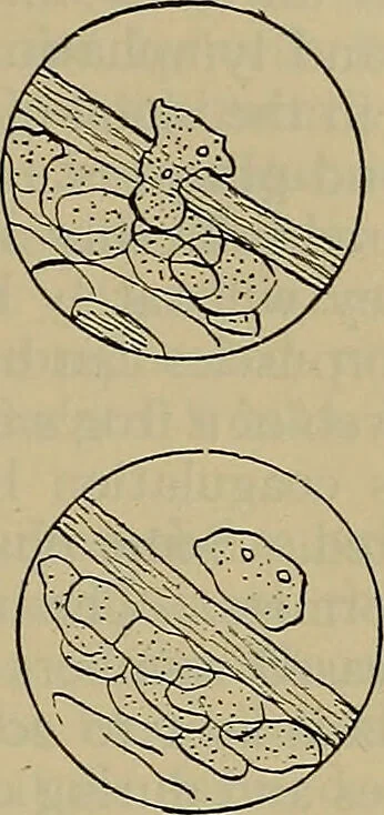An illustration from Modern surgery, general and operative / by John Chalmers DaCosta., 1914, leaf 85