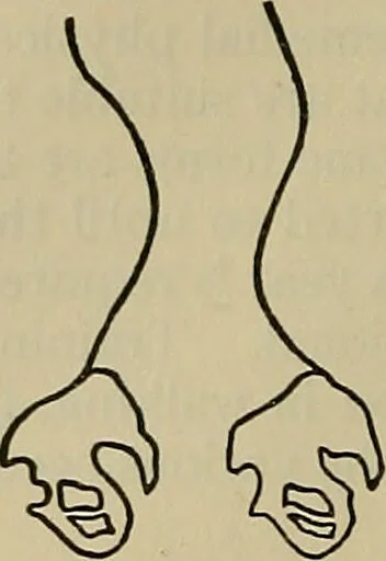 An illustration from Modern surgery, general and operative / by John Chalmers DaCosta., 1914, leaf 868