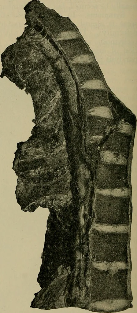 An illustration from Modern surgery, general and operative / by John Chalmers DaCosta., 1914, leaf 878